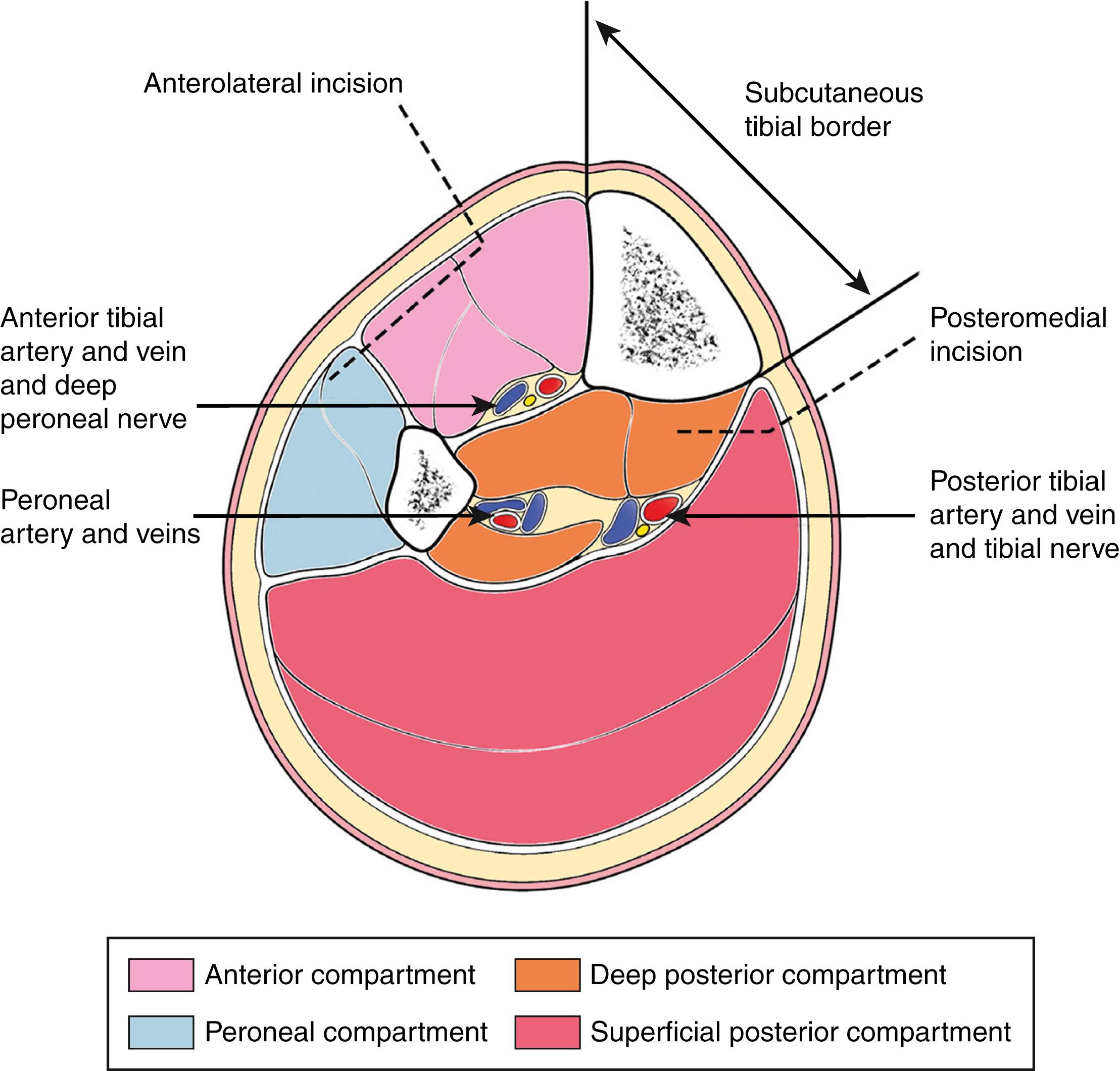 Fig. 43.2, Cross-section through the leg showing incisions to decompress all four compartments. The medial incision is situated 1.5 cm from the medial subcutaneous border of the tibia. The lateral incision is placed 2 cm lateral to the lateral subcutaneous tibial border. The lateral dissection continues subfascially until the peroneal septum, which must then be divided.