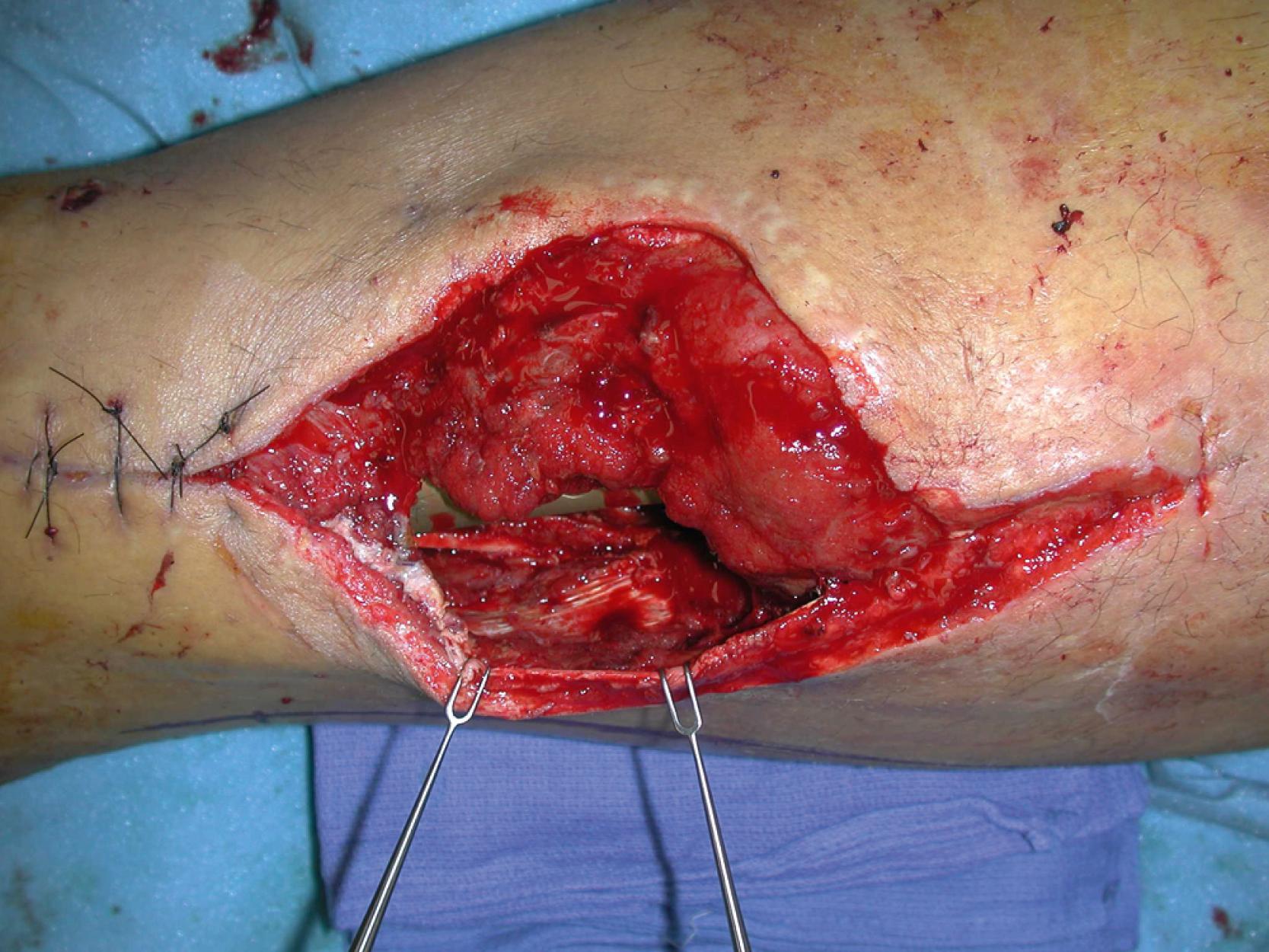 Fig. 41.2, A preoperative close-up view showing potential dead space around the fracture site after open reduction and internal fixation.