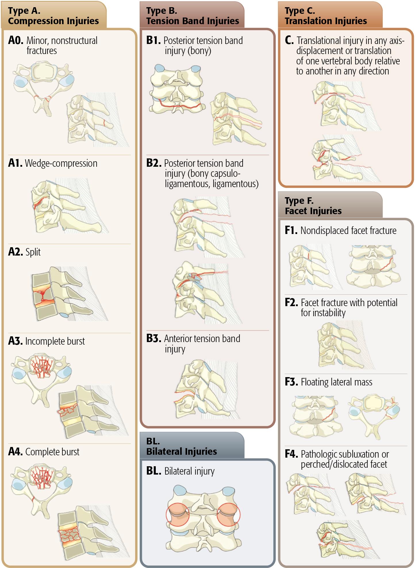 Fig. 57.1, The AOSpine Subaxial Injury Classification System.