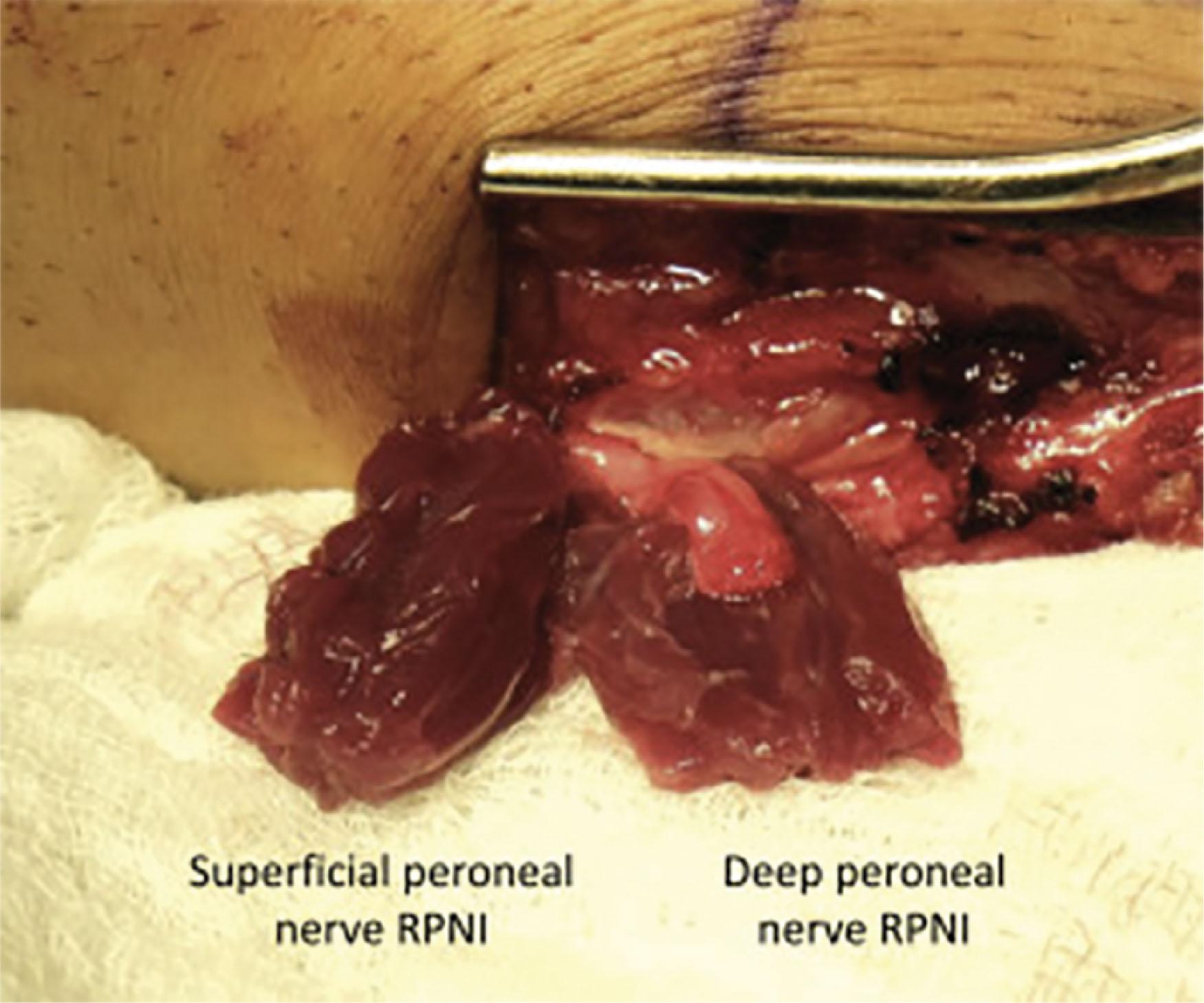 Figure 6.3.1, RPNIs of the superficial peroneal nerve (left, complete) and deep peroneal nerve (right, in progress). After excision of neuroma (if present) and trimming the nerve to healthy appearing axons, RPNIs are created by securing the epineurium of the terminal end of the peripheral nerve (or its fascicle) to the epimysium of the skeletal muscle graft using non-absorbable monofilament sutures. The edges of the muscle graft are then secured to each other using non-absorbable monofilament sutures. Final RPNIs are placed in a well-vascularized wound bed and away from sites of compression.