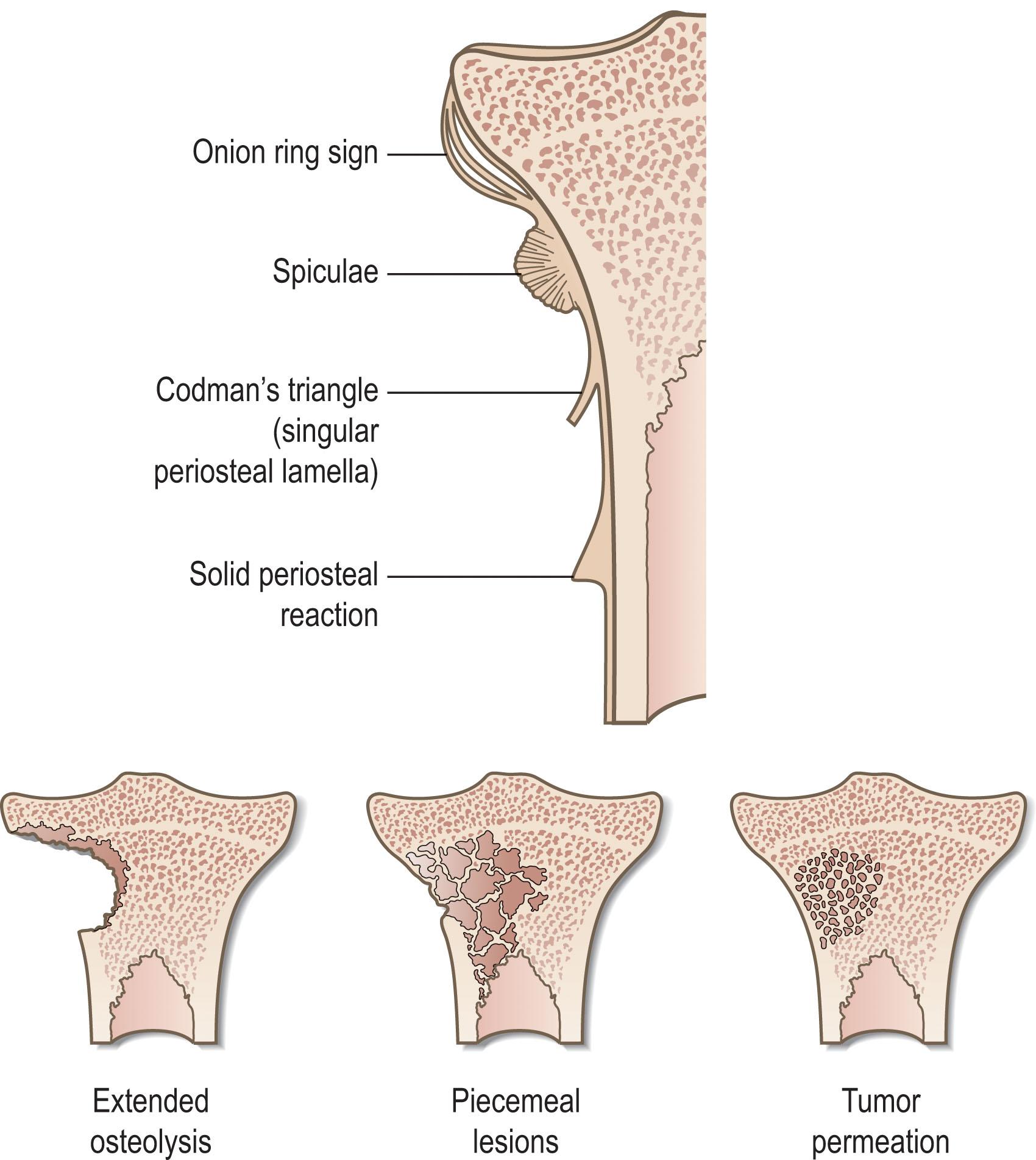 Figure 4.2, Typical radiologic features of malignant and benign primary osseous tumors.