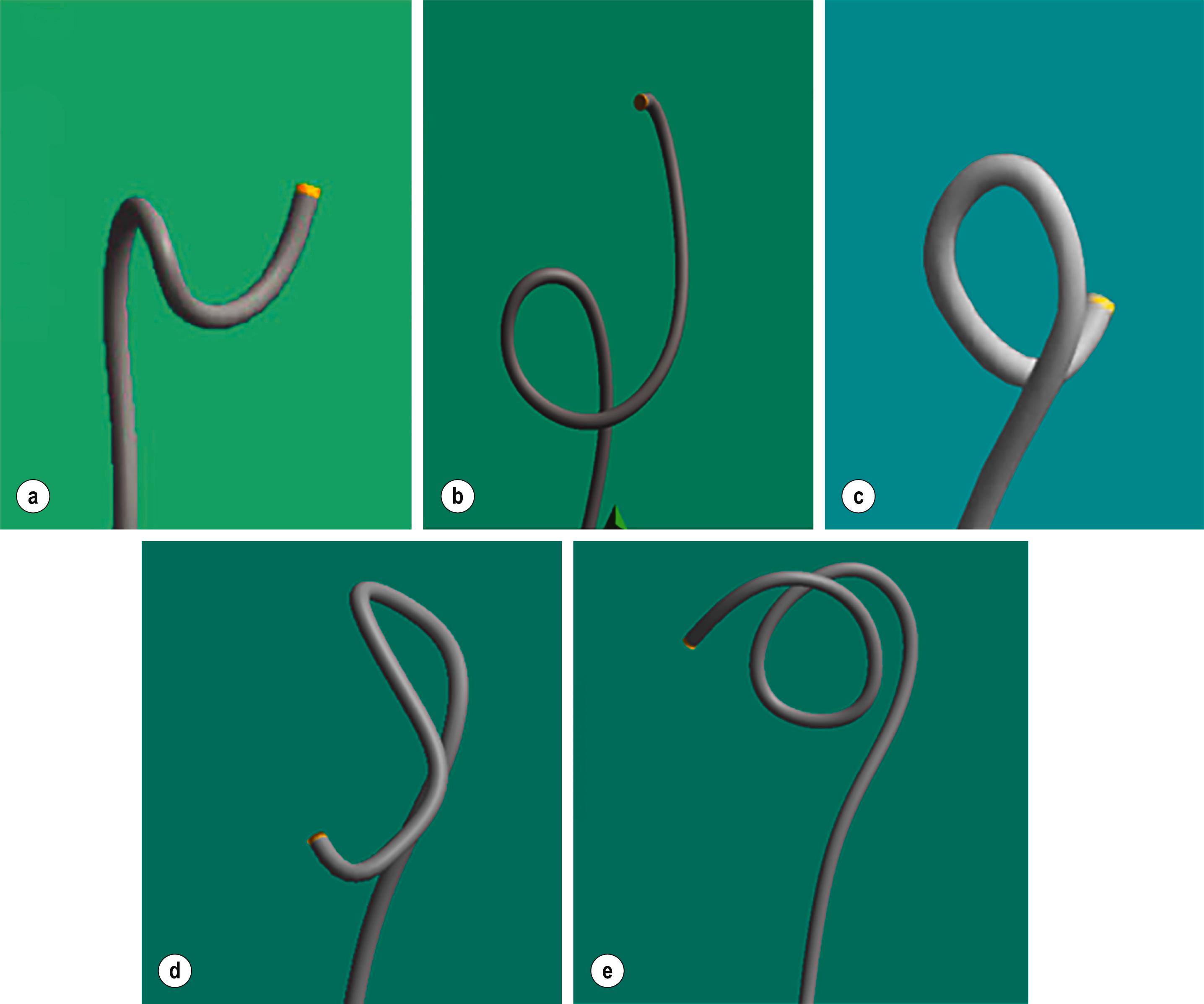 Figure 1.2, ScopeGuide images of: (a) sigmoid N-loop; (b) alpha loop; (c) reverse alpha loop; (d) deep transverse loop; (e) gamma loop.