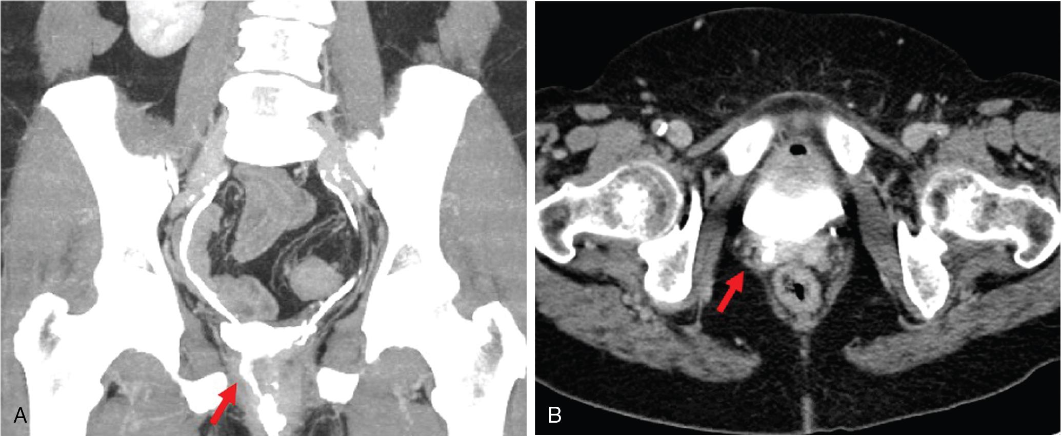 Fig. 38.1, Computed tomography (CT) urography can be useful to demonstrate ureterovaginal fistulas that are not identified on physical exam. Coronal ( A ) and axial ( B ) cuts of a CT urogram demonstrate a distal right ureterovaginal fistula ( red arrow ).