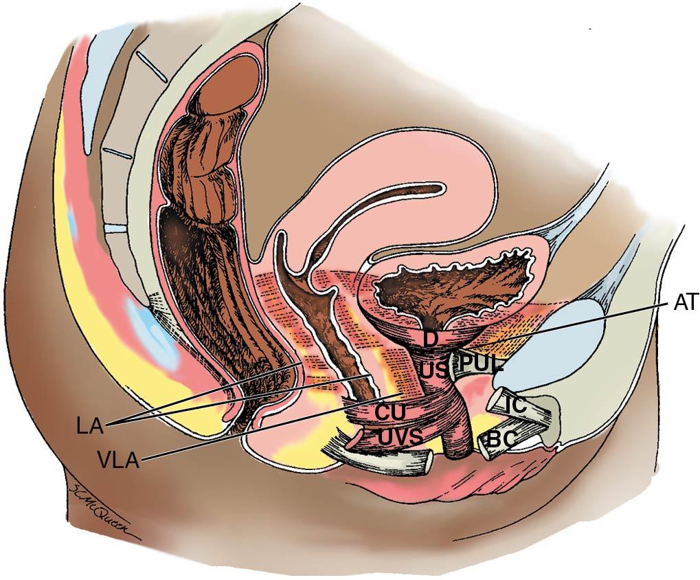Fig. 21.6, Interrelationships of approximate location of paraurethral structures. Levator ani muscles are shown as light lines running deep to the pelvic viscera. The vaginal levator attachment is shown as a darker area. AT, Arcus tendineus fasciae pelvis; BC, bulbocavernosus muscle; CU, compressor urethrae; D, detrusor muscle; IC, ischiocavernosus muscle; LA, levator ani muscles; PUL, pubourethral ligament; US, urethral sphincter; UVS, urethrovaginal sphincter; VLA, vaginal levator attachment.