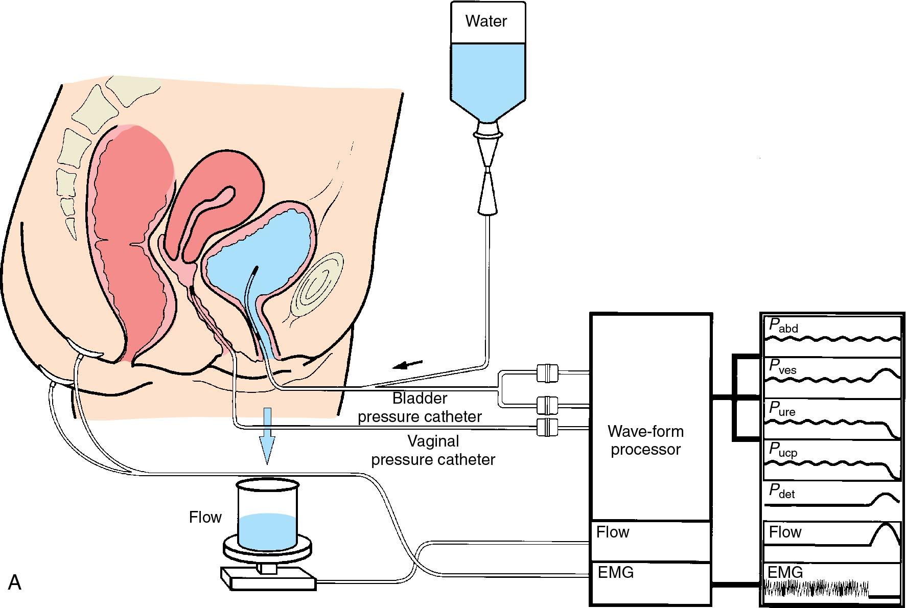 Fig. 21.8, A, Multichannel urodynamics. B, Urodynamic test showing dysfunctional voiding. EMG, Electromyography; P abd , abdominal pressure; P det, true detrusor pressure; P ure , urethral pressure; P ucp , urethral closure pressure; P ves , bladder pressure.