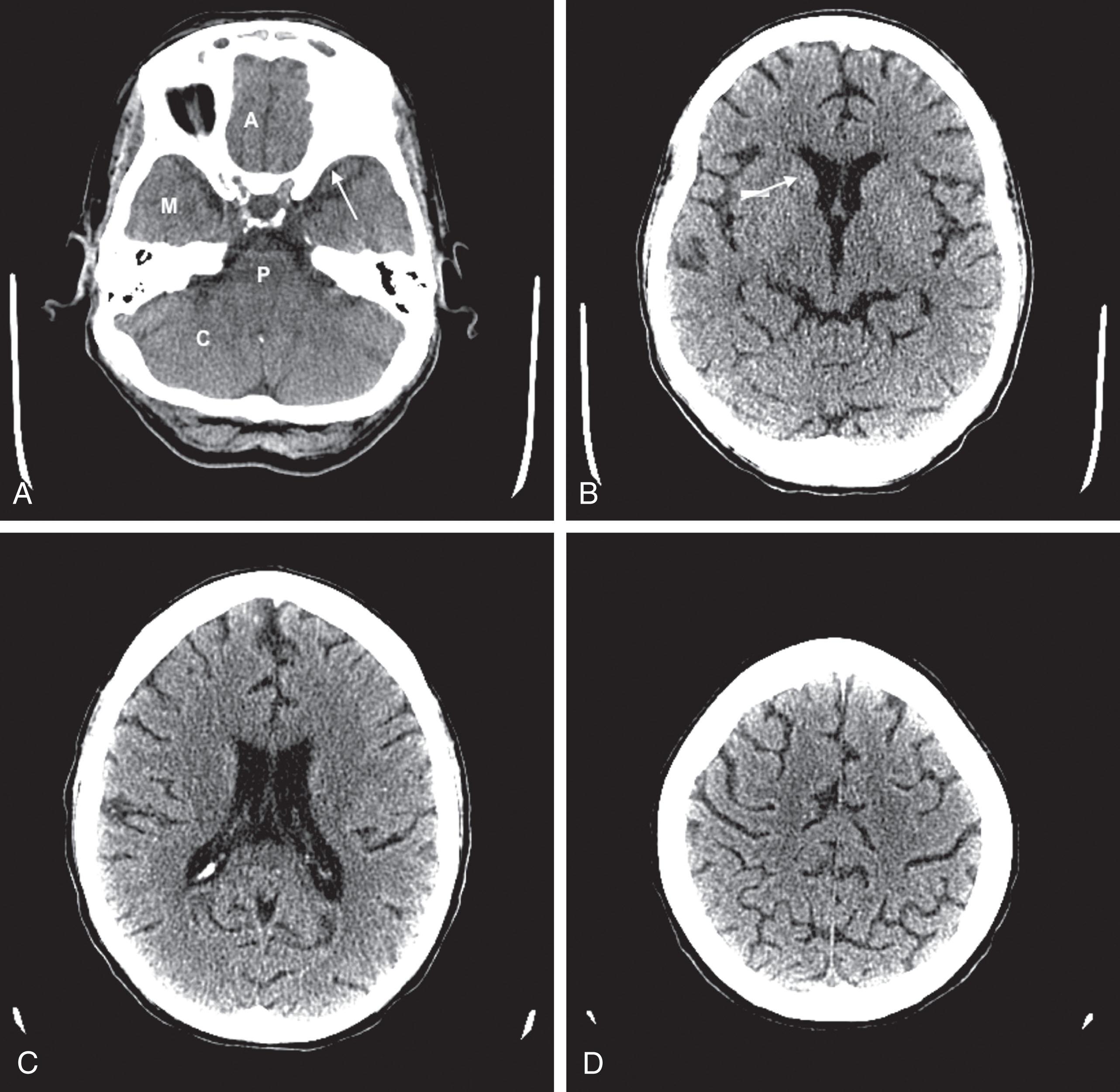 Fig. 20.1, These computed tomography (CT) scans show progressively higher axial images of a normal brain. (A) The anterior cranial fossae (A) contain the anterior frontal lobes and the olfactory nerves. The middle fossae (M) contain the anterior temporal lobes situated behind the bony sphenoid wing (arrow) . The posterior fossa contains the cerebellum (C) and the medulla and pons (P) —major components of the bulb . (B) The head of the caudate nucleus (arrow) indents the anterior horn of the lateral ventricle. (C) The lateral ventricles extend lengthwise in the hemispheres. (D) The cerebral cortex rests against the inner table of the skull. Thin sulci separate the gyri.