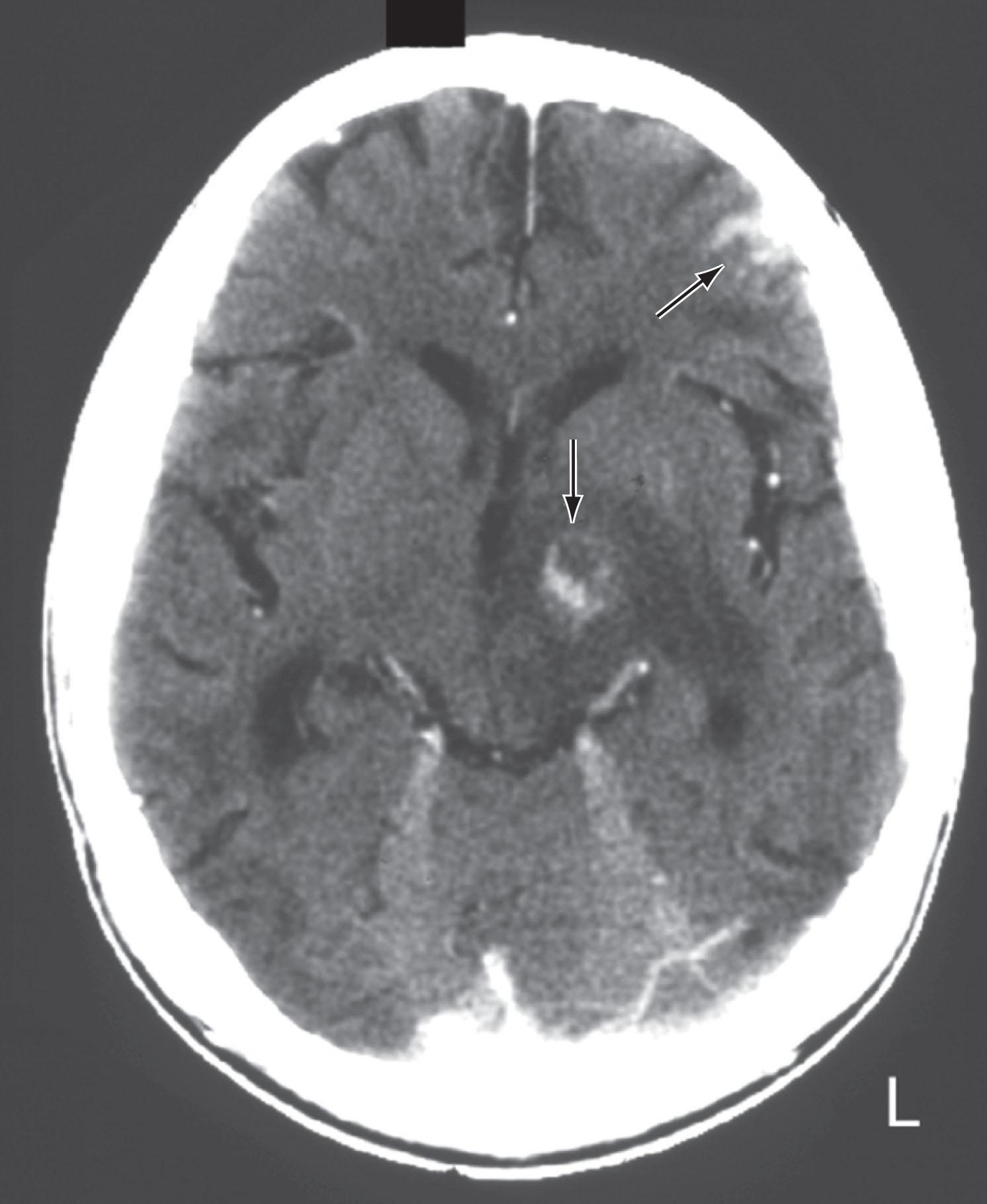 Fig. 20.11, A contrast-enhanced CT shows two toxoplasmosis lesions ( arrows ) in the left cerebrum in a patient with AIDS. As in this study, toxoplasmosis has a predilection for developing in the basal ganglia in AIDS patients with CD 4 counts below 200 cells/mm 3 .