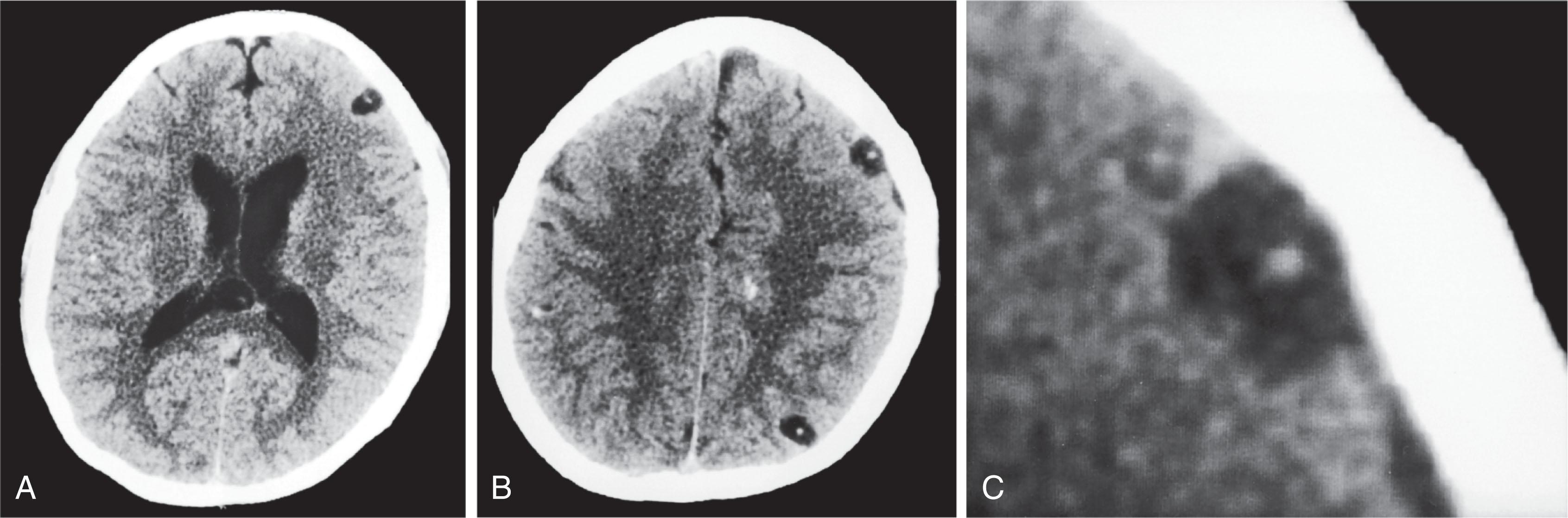 Fig. 20.12, This CT shows multiple cerebral lesions—from cysticercosis—at two levels in the cerebrum (A and B) and an enlargement of the frontal cortex lesion (C). In contrast to toxoplasmosis lesions ( Fig. 20.11 ), cysticercosis lesions are usually situated in the cerebral cortex, contain calcification, and lack surrounding edema.