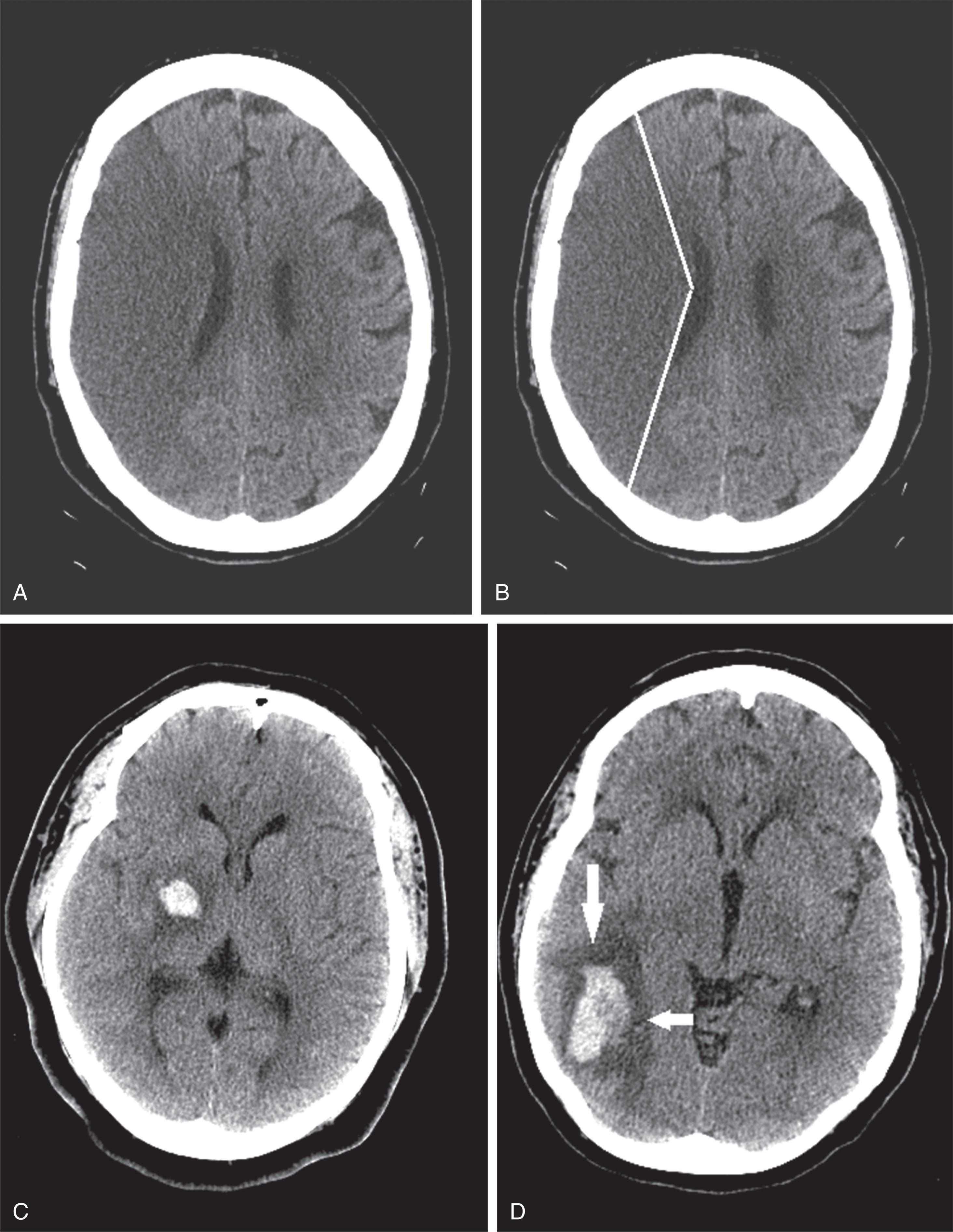 Fig. 20.13, (A) This CT image shows an acute stroke from occlusion of the right middle cerebral artery. Because the infarcted area is deprived of blood, it is darker (more hypodense) than the normal brain. (B) An outline of the stroke shows its large pie-shaped area lateral to the right cerebral hemisphere. (C) This image shows a cerebral hemorrhage in the right thalamus that likely originated from hypertension. (D) In this image, a hemorrhage (arrows) , surrounded by edema (black) , is situated in the right parietal lobe and compresses the occipital horn of the right lateral ventricle.