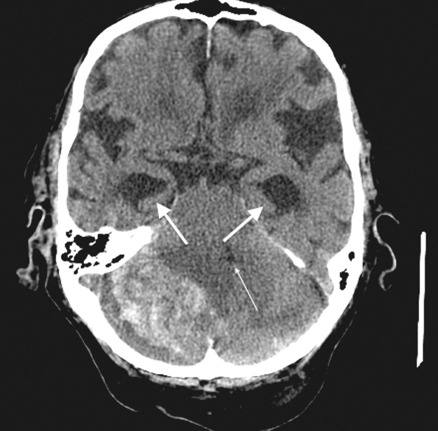 Fig. 20.14, This CT shows a large, patchy, hyperdense lesion in the posterior fossa. The lesion is a cerebellar hemorrhage that has compressed and shifted the fourth ventricle (thin arrow) , blocking cerebrospinal fluid passage. The resulting obstructive hydrocephalus has caused dilation of the temporal horns of the lateral ventricles (arrows) .