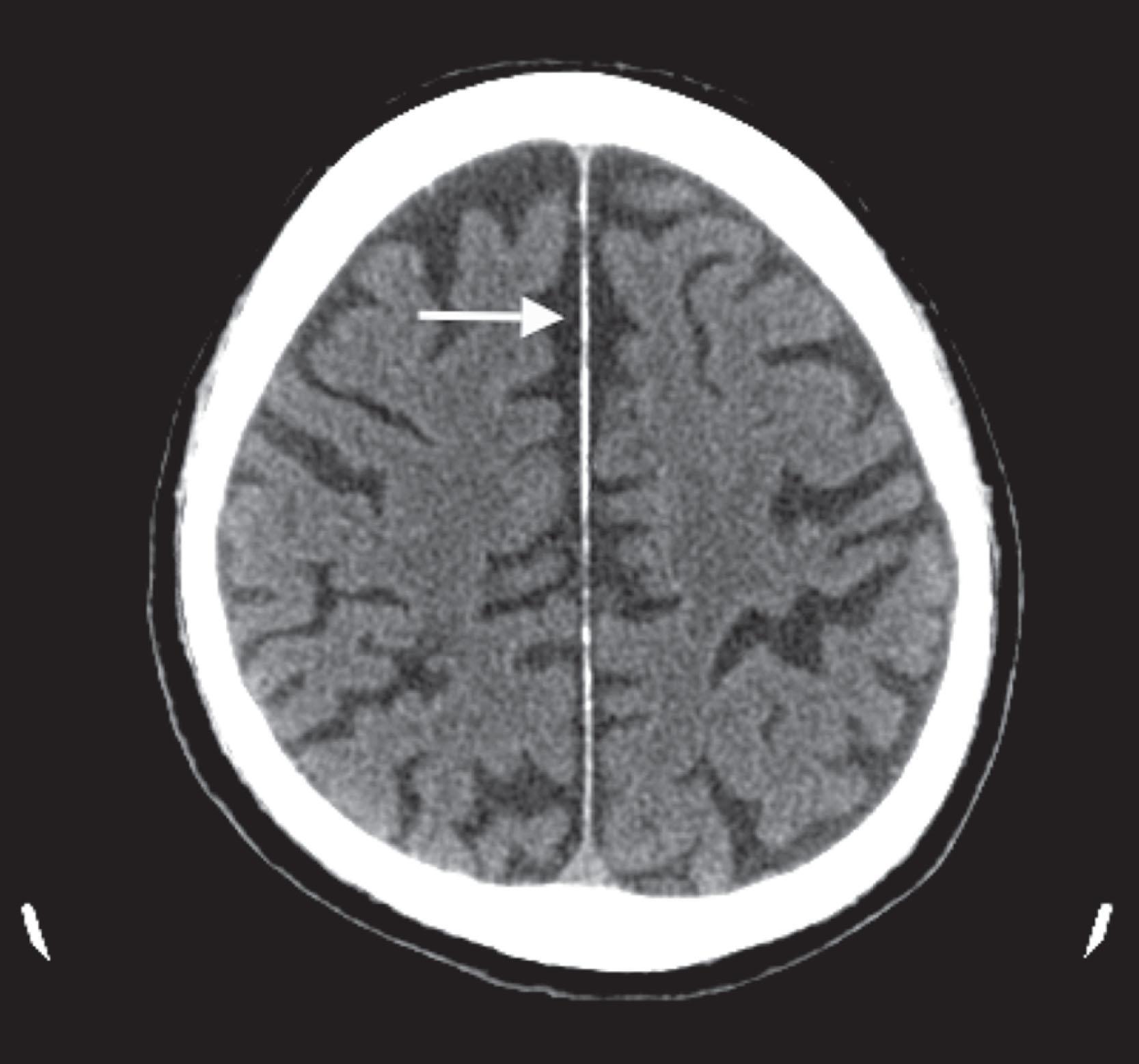 Fig. 20.2, This CT illustrates generalized cerebral atrophy. (See Fig. 20.18 for MRI appearance of cerebral atrophy): the gyri shrink, sulci expand, and the cerebral cortex retracts from the inner table of the skull and from the falx (arrow) . Cerebral atrophy is associated with normal age, Alzheimer disease and other neurodegenerative illnesses, trisomy 21, alcoholism, and treatment-resistant schizophrenia; however, it is not invariably associated with dementia.