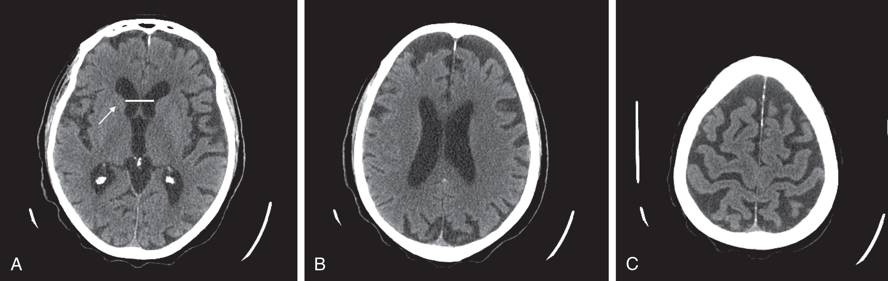 Fig. 20.3, These three progressively higher (left to right) CT images show that cerebral atrophy leads to expansion of the lateral ventricles (horizontal line) and widening of the third ventricle— hydrocephalus ex vacuo —as well as thinning of cerebral gyri and widening of sulci (right-most image). Nevertheless, as the left-most image shows, the head of the caudate nucleus (arrow) maintains its normal volume and continues to indent the lateral border of the lateral ventricle. In Huntington disease, by way of contrast, the characteristic atrophy of the head of the caudate nuclei allows the ventricles to bow outward (see Fig. 20.5 ).
