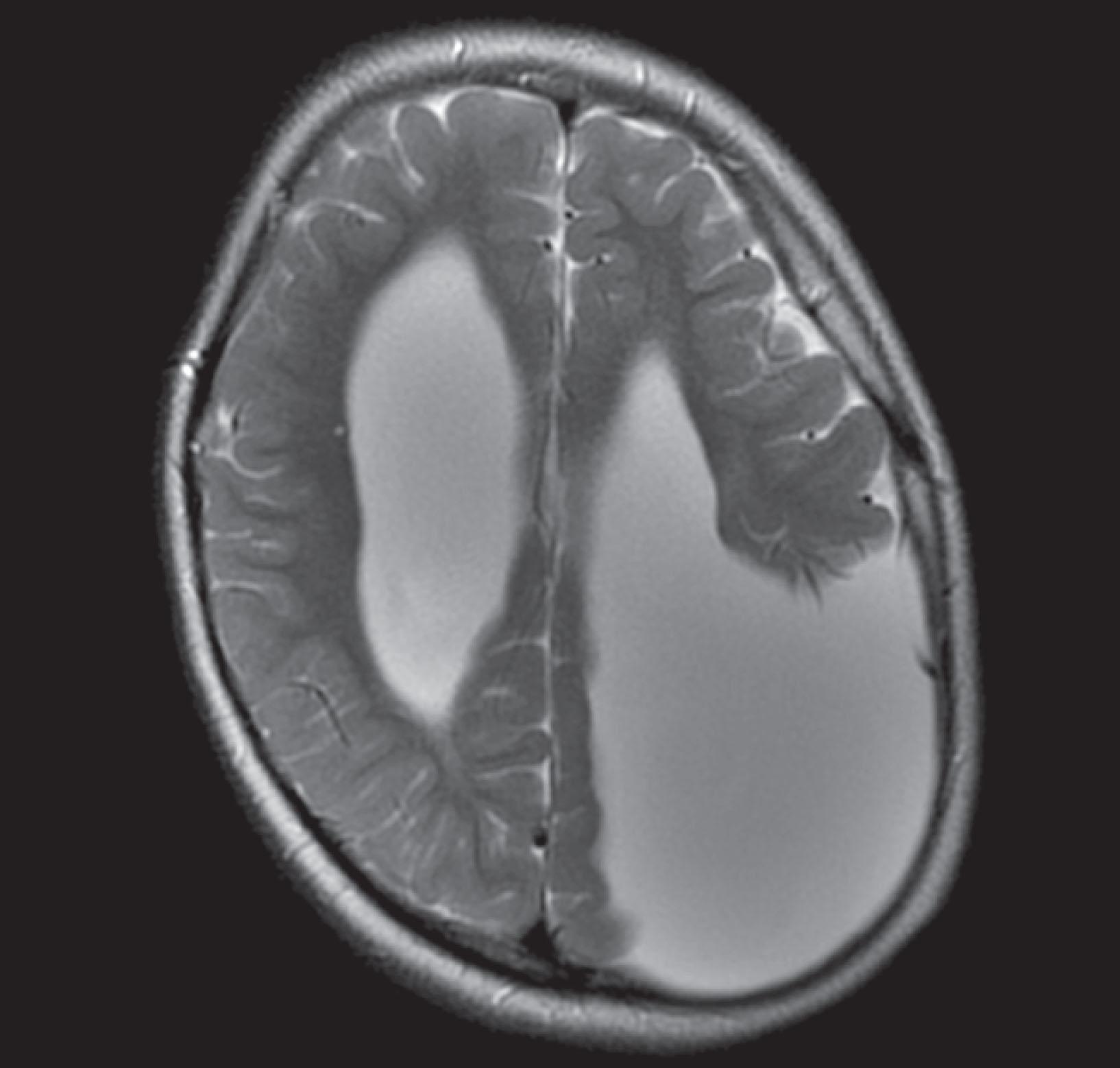 Fig. 20.4, CT and MRI, by convention, display the brain with its lateral sides reversed. For example, the left cerebral hemisphere appears on the right side of the CT image. Nevertheless, the frontal lobes still appear on the top on the image. In this MRI, the misshapen region filled with cerebrospinal fluid in the parietal lobe represents a congenital absence of brain tissue, porencephaly , in the left parietal lobe. The porencephaly displays the opposite effect of a mass lesion: the porencephaly draws the adjacent lateral ventricle toward it.