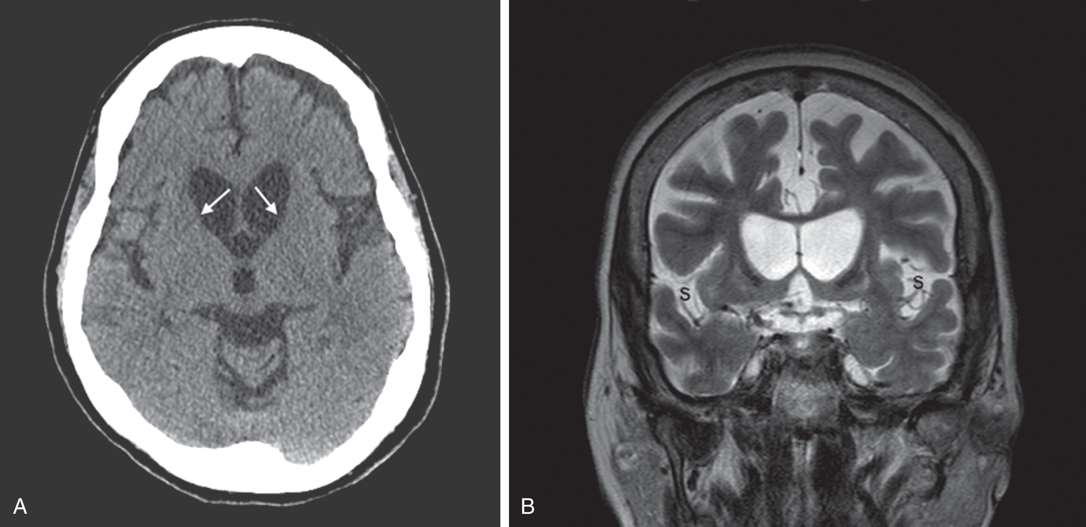 Fig. 20.5, (A) This CT shows the characteristic abnormality of Huntington disease: the anterior horns of the lateral ventricles are convex (bowed outward) because of atrophy of the caudate nuclei (arrows) . The convex shape of the ventricles in Huntington disease contrasts with the concave shape seen in normal individuals ( Figs. 20.1B and 20.17 ) and even in those with cerebral atrophy and hydrocephalus ex vacuo ( Figs. 20.2, 20.3, and 20.18 ). In addition to the caudate atrophy, Huntington disease, like other neurodegenerative illnesses, is associated with cortical atrophy with widened sulci and enlarged ventricles. (B) This coronal view of the MRI of the same patient with Huntington disease also shows the convex expansion of the lateral ventricles, large sulci, and widened sylvian fissures (S) .