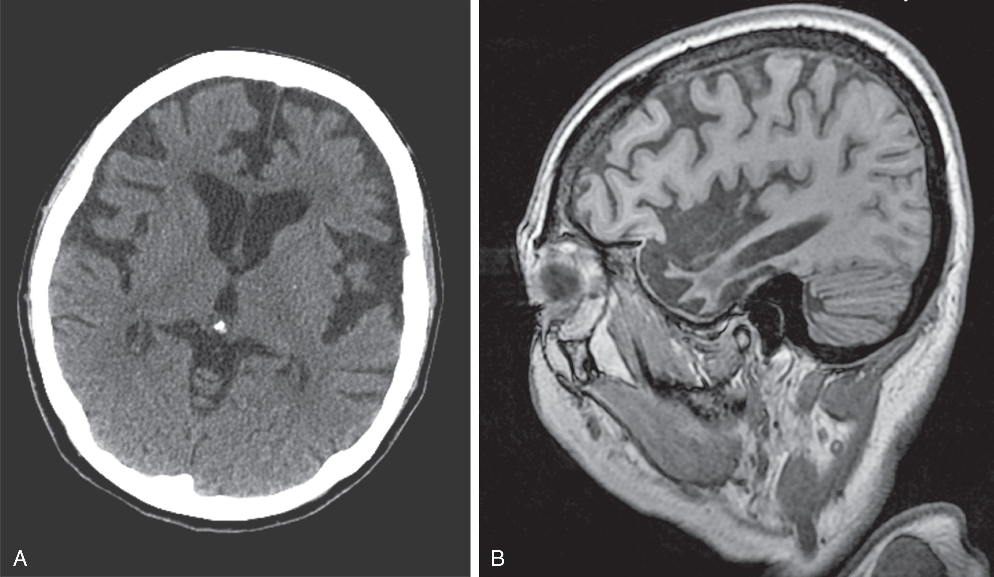 Fig. 20.6, (A) This CT from a patient with frontotemporal dementia shows the characteristic atrophy of the frontal and temporal lobes. The parietal and occipital lobes remain unchanged. (B) A sagittal MRI from another patient with frontotemporal dementia shows the selective frontal and temporal lobe atrophy.