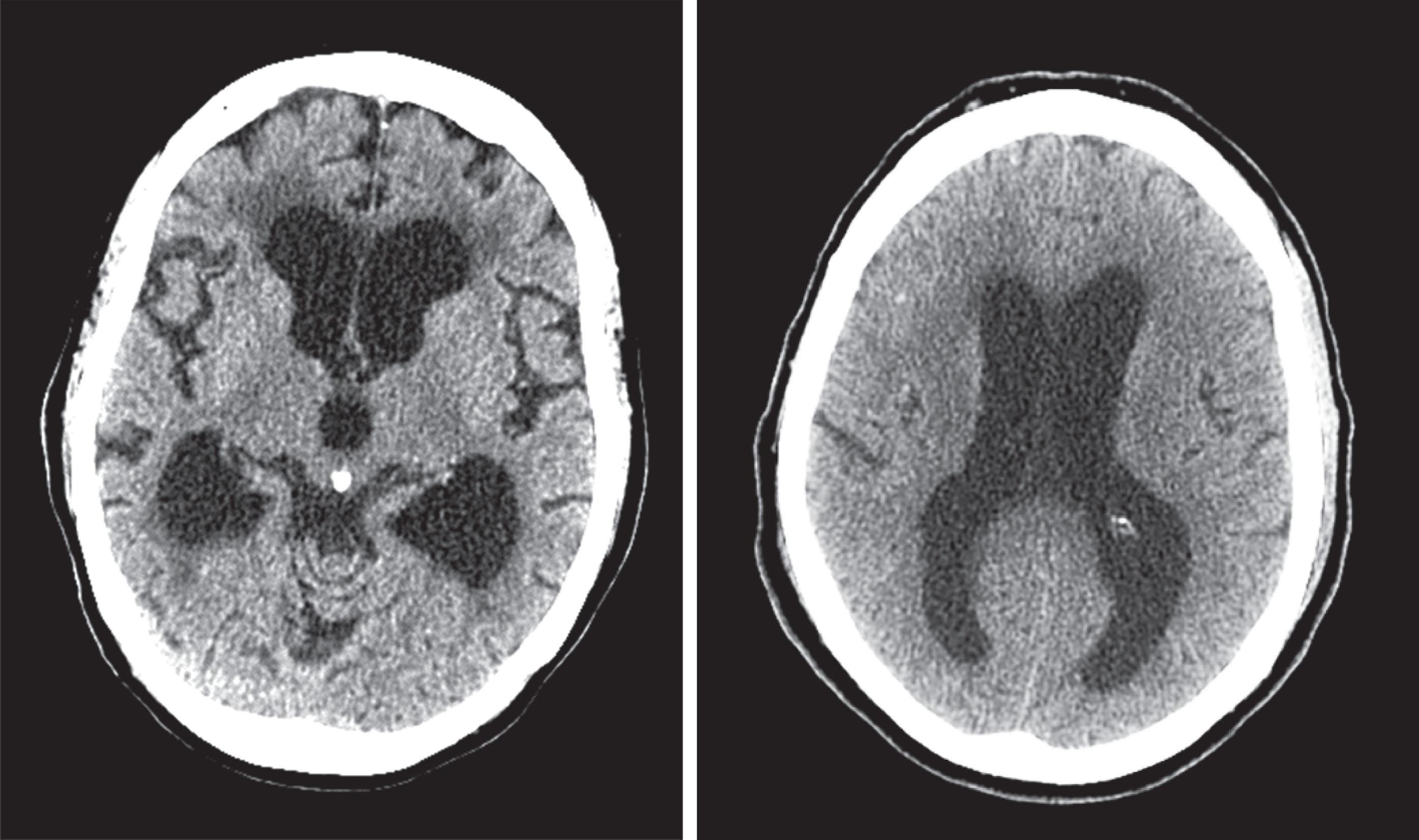 Fig. 20.7, CTs of two patients with normal pressure hydrocephalus (NPH) show wide third and lateral ventricles but little or no cerebral atrophy. (See Fig. 20.19 for MRI of NPH).