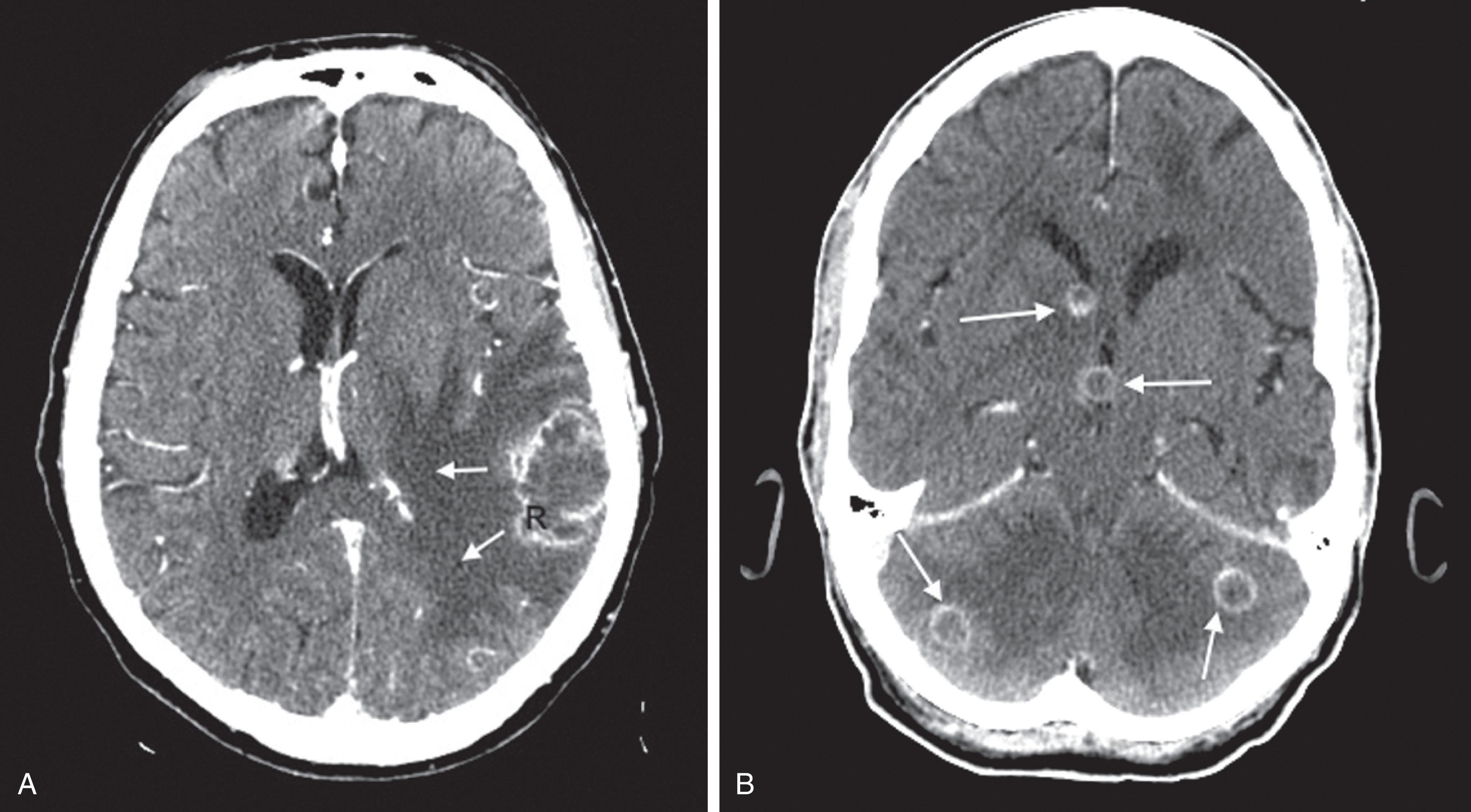 Fig. 20.8, (A) CT shows a glioblastoma with its characteristic white, contrast-enhanced ring ( R ) and black border of edema ( open arrows ). (See Fig. 20.20 for MRI showing a glioblastoma.) (B) This CT shows several contrast-enhanced metastatic tumors ( arrows ).