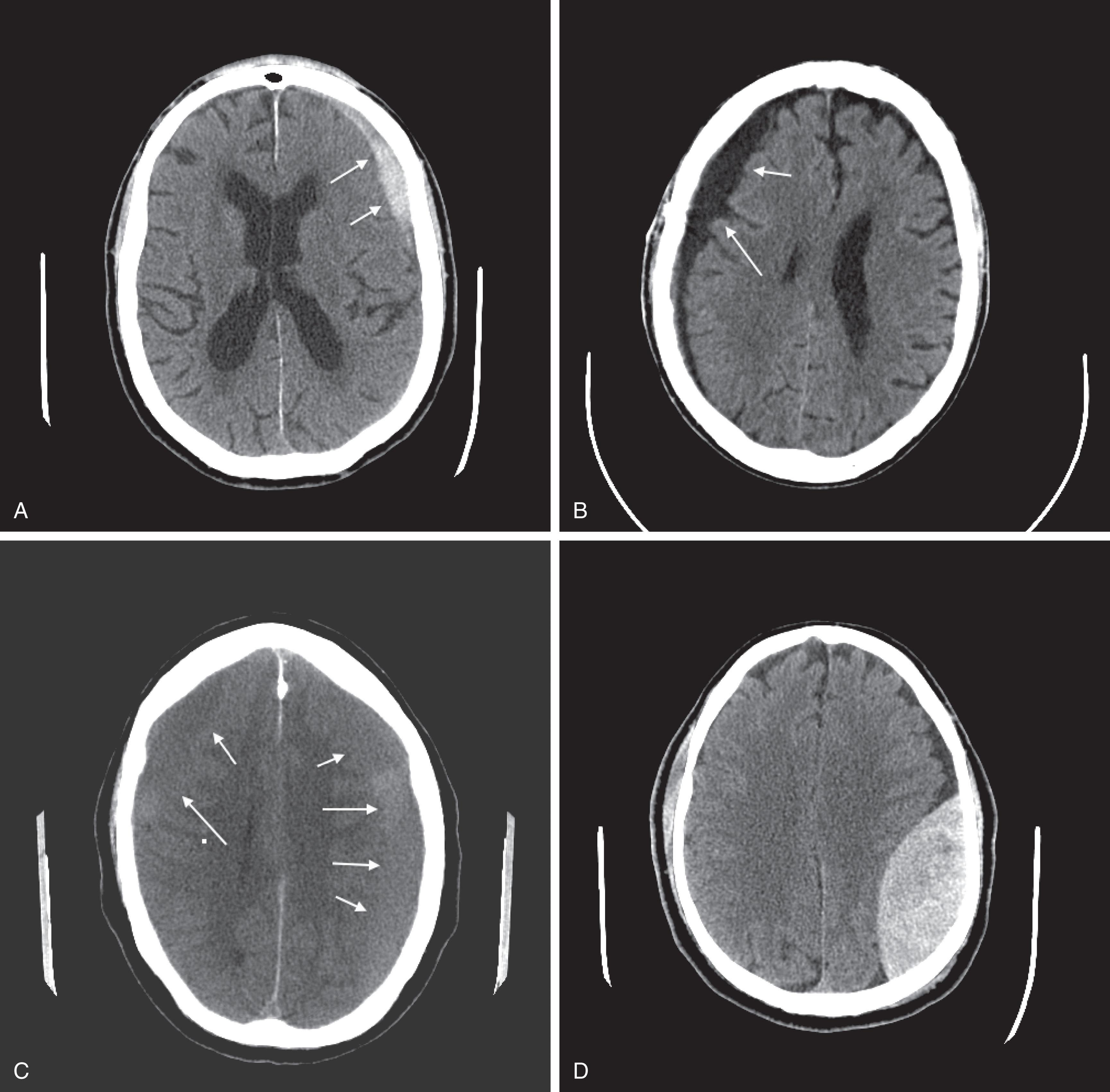 Fig. 20.9, (A) An acute subdural hematoma (arrows) overlying the left frontal lobe contains fresh blood and is therefore radiodense (white) compared to normal brain. (B) A chronic subdural hematoma (arrows) , overlying the right cerebral hemisphere, contains aged, liquefied blood less radiodense (black) than brain. (C) A 2-week-old subdural, overlying both cerebral hemispheres, is isodense (gray) compared to normal brain and thus barely discernible. (D) An acute epidural hematoma, typically elliptical and white, compresses the underlying brain.