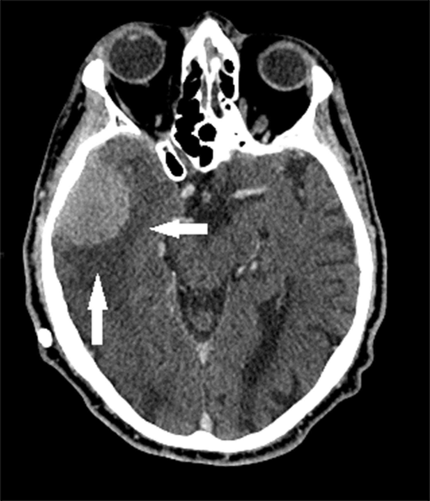 Fig. 20.10, A contrast-enhanced axial CT shows a large, rounded radiodense right temporal lesion, with a dural margin and some local edema (arrows) . The lesion is typical of a chronic, slowly growing meningioma.