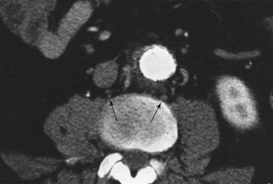 FIGURE 1, Computed tomographic scan showing paravertebral location of lumbar sympathetic chains (arrows).