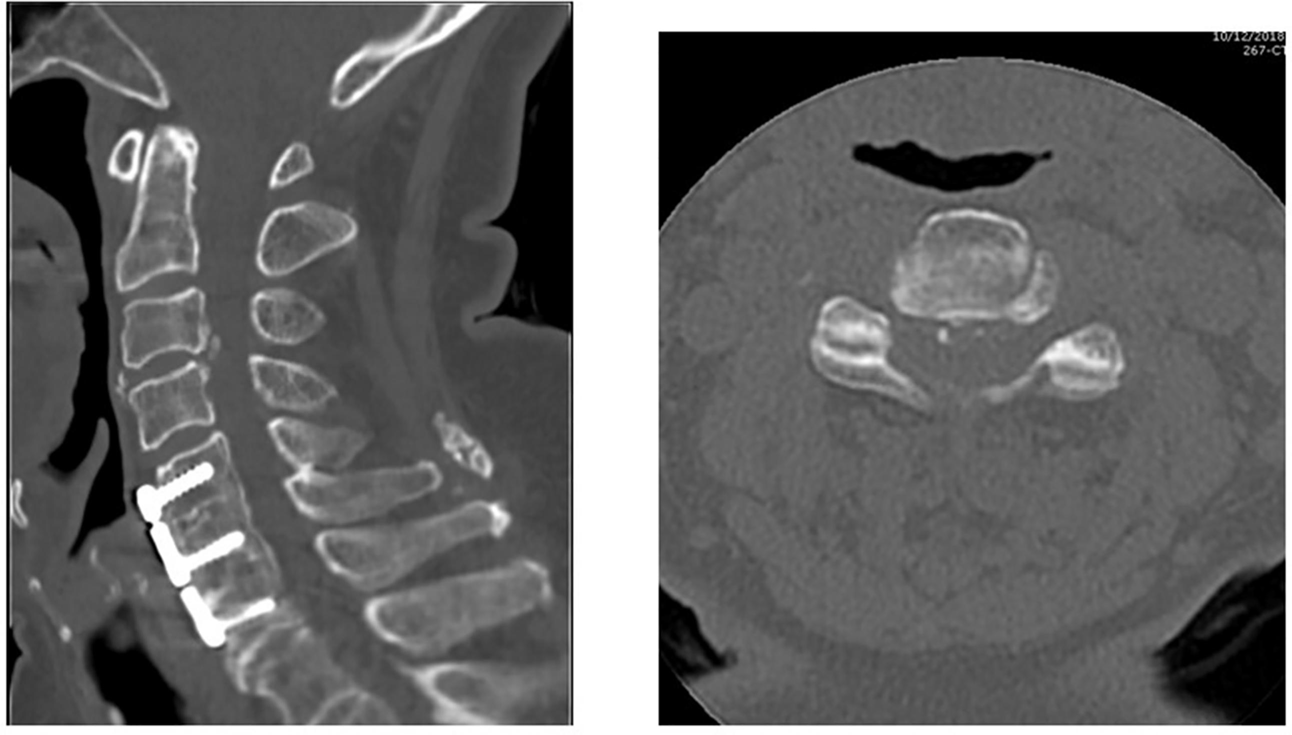 Fig. 1, Sagittal and axial computed tomography of the cervical spine demonstrating localized ossification of the posterior longitudinal ligament (OPLL) at the C3–4 disc space.