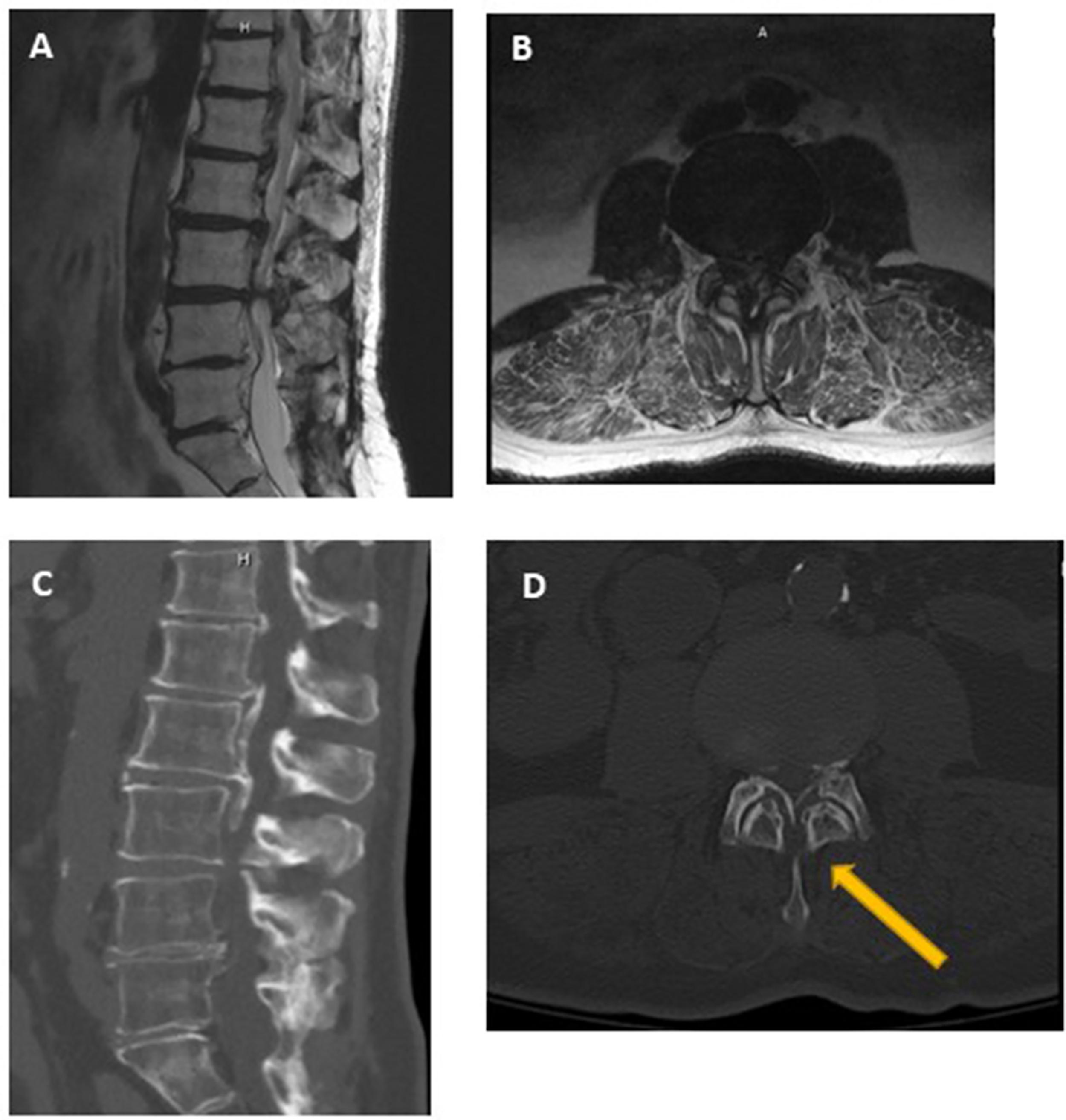 Fig. 2, (A) T2-weighted midsagittal MRI slice of the lumbar spine demonstrating significant multilevel stenosis secondary to spondylosis and a multisegment retrovertebral mass; (B) T2-weighted axial MRI image of the lumbar spine. Noted is severe central and subarticular stenosis secondary to circumferential compression; (C) Mid-sagittal CT image of the lumbar spine clearly delineates the etiology of the retrovertebral mass—continuous-type ossification of the posterior longitudinal ligament. Retrothecal ossification is also noted; (D) Axial CT image of the lumbar spine demonstrates ossified ligament flavum as the source of retrothecal compression.