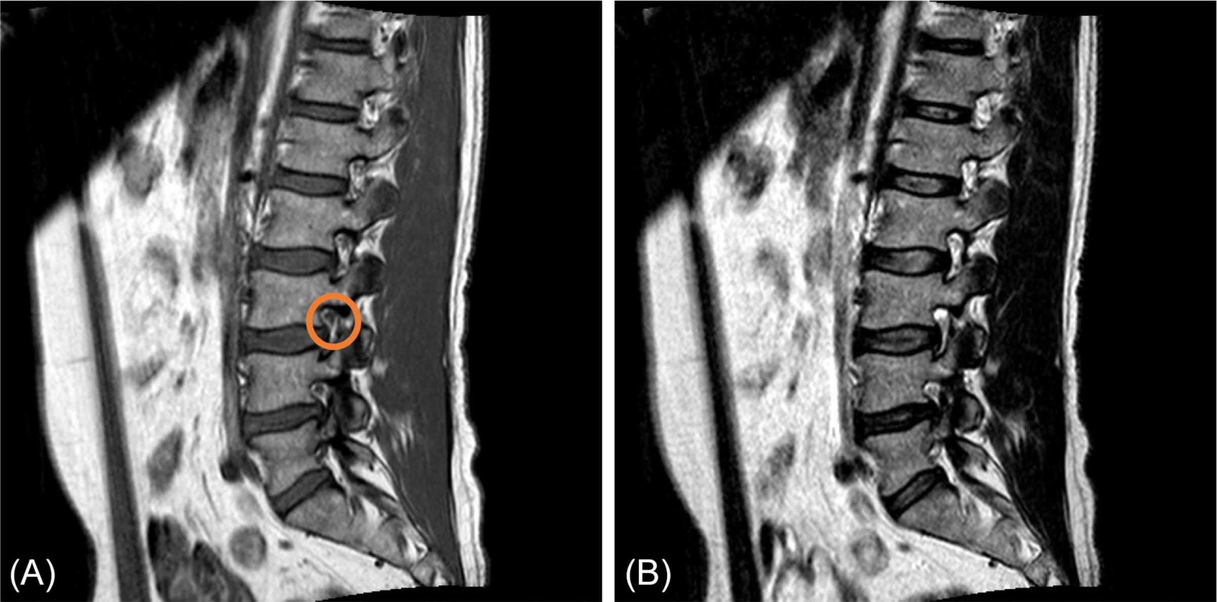 Fig. 3, (A) T1-weighted image through lumbar foramina (circle); (B) T2-weighted image through same lumbar foramina.