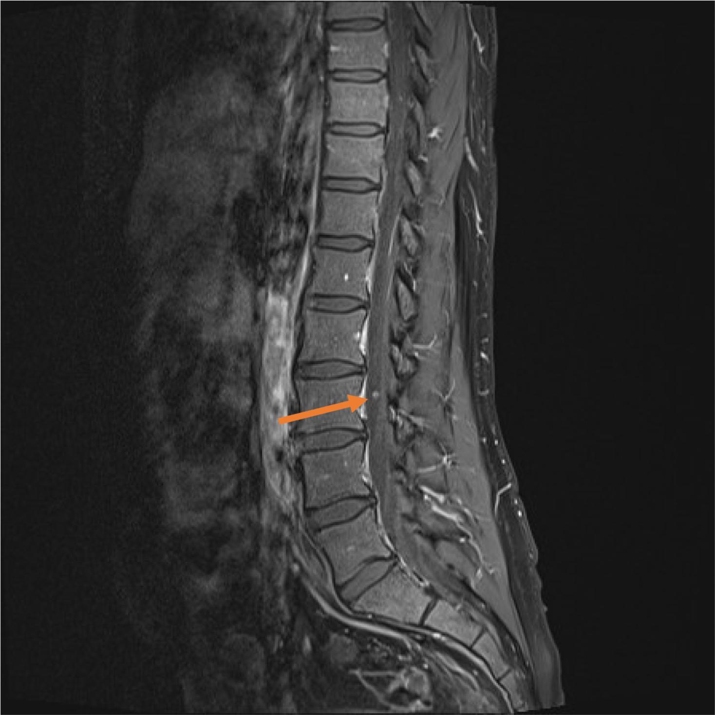 Fig. 4, T1-weighted image after administration of gadolinium. Nodular enhancement at the L3 level (arrow) in a patient with anaplastic ependymoma, suspect of leptomeningeal metastases.