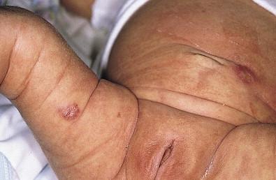 Figure 26.2, Multicentric cutaneous myofibromas in an infant with extensive bone lesions.