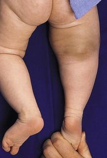 Figure 26.5, Desmoid fibromatosis: firm mass on the thigh of an infant, diagnosed as ‘aggressive fibromatosis of infancy.’