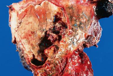 Figure 10.11, Large lung abscess.