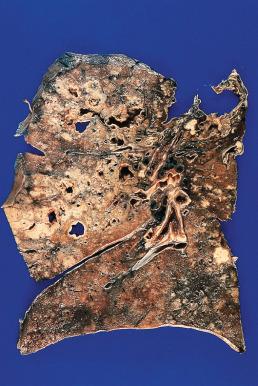 Figure 10.12, Massive destruction of lung parenchyma by tuberculosis.