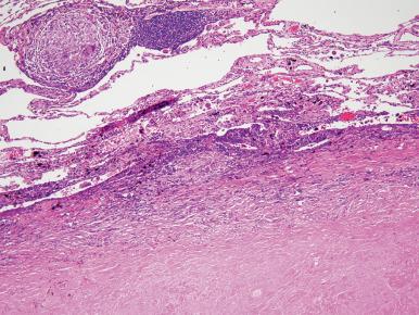 Figure 10.14, Tuberculosis. An area of caseous necrosis is bounded by a mixed inflammatory infiltrate that includes epithelioid and multinucleated histiocytes. A sarcoidal non-necrotizing granuloma accompanied the necrotizing granuloma.