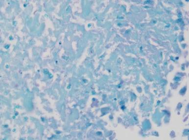 Figure 10.15, Tuberculosis. Ziehl–Neelsen stain demonstrating two acid-fast bacilli.