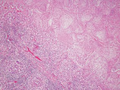 Figure 10.16, Atypical mycobacteriosis due to MAC. An area of necrosis showing ‘infarct-like’ features is surrounded by an inflammatory infiltrate that includes epithelioid and multinucleated histiocytes. Loose clusters of epithelioid and multinucleated giant cells also form non-necrotizing granulomas at the periphery. These histologic features are indistinguishable from those seen with other infectious granulomatous diseases including tuberculosis. Cultures from this case grew M. avium complex.