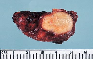 Figure 10.17, Coccidioidomycotic granuloma. The necrotic center is surrounded by fibrous tissue showing concentric lamination.