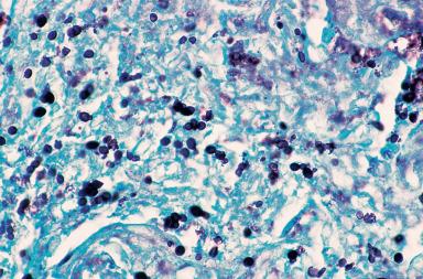 Figure 10.18, Pulmonary histoplasmosis. The organisms are demonstrated with the Grocott stain and are relatively small (1–5 µm) with a characteristic oval or teardrop shape.