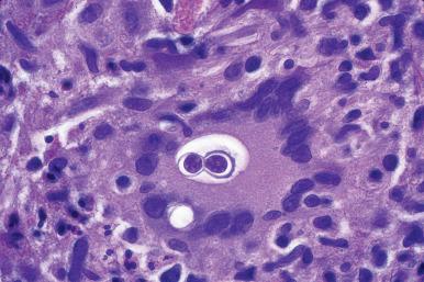 Figure 10.19, Pulmonary blastomycosis. Microscopic appearance of B. dermatitidis in a hematoxylin and eosin stain. The organisms are large (8–15 µm) with a doubly refractile wall and basophilic nucleus.