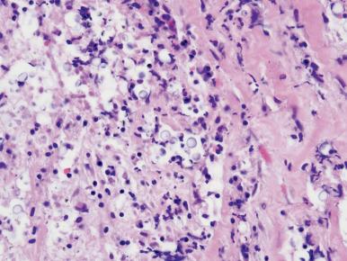 Figure 10.20, Pulmonary cryptococcosis. Microscopic appearance of C. neoformans in a hematoxylin and eosin stain. Variably sized, round, and occasionally fractured yeast are intermediate in size (4–7 µm) and have pale staining, thin walls with associated halos.