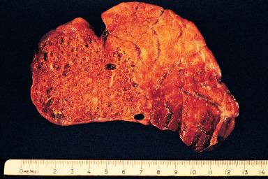 Figure 10.2, Gross appearance of congenital cystic adenomatoid malformation of lung.