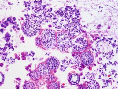 Figure 10.22, Microscopic appearance of C. immitis in a hematoxylin and eosin stain. Large (30–60 µm) intact and ruptured spherules contain much smaller (2–5 µm) endospores. In this example there are also mycelia (upper right) which is an uncommon finding.