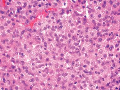 Figure 10.23, Disseminated histoplasmosis. Sheets of histiocytes demonstrate numerous organisms within their cytoplasm.