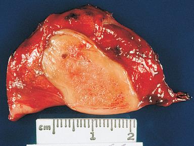 Figure 10.24, Sharply outlined lung infarct resulting from Dirofilaria infestation.