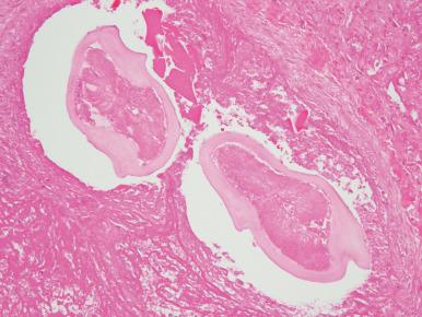 Figure 10.25, Microscopic appearance of D. immitis within the necrotic center of a dirofilarial nodule.