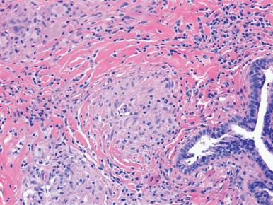 Figure 10.26, Sarcoidosis. Well-formed granuloma characteristic of sarcoidosis with characteristic collaret of coarse collagen bundles.