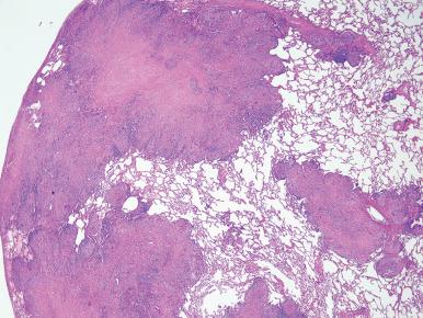 Figure 10.27, Sarcoidosis. Numerous granulomas with associated fibrosis form conglomerate nodules that expand visceral pleura, interlobular septa, and bronchovascular bundles in a characteristic ‘lymphangitic’ pattern.