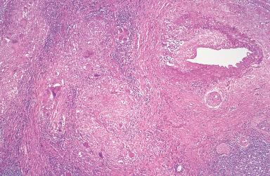 Figure 10.28, Necrotizing sarcoid granulomatosis. There is extensive involvement of large vessels by the inflammatory infiltrate, which has a necrotizing quality. Most authorities consider this a variant of nodular sarcoidosis.