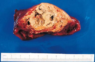 Figure 10.29, Granulomatosis with polyangiitis (Wegener's). The lesion is well circumscribed, with a granulomatous and partially necrotic appearance.