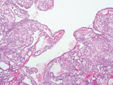 Figure 10.3, Microscopic appearance of large cyst (Stocker type 1) congenital cystic adenomatoid transformation. A large cystic air spaces is lined by ciliated respiratory epithelium and mucinous gastric-like epithelium is scattered throughout the adjacent lung parenchyma.