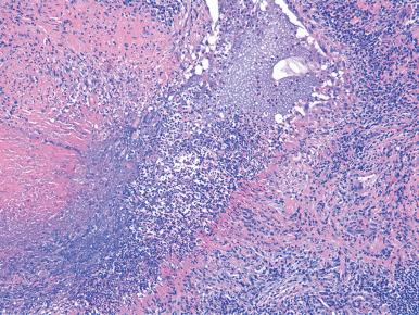 Figure 10.31, Bronchocentric variant of granulomatosis with polyangiitis (Wegener's) in which the necrosis is centered an airway lumen and the airway wall partially replaced by a granulomatous infiltrate comprising palisaded histiocytes.